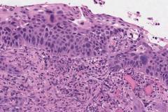 Invasive squamous cell carcinoma arising from severe keratinizing squamous dysplasia