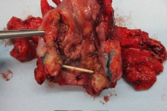 Squamous cell carcinoma of the larynx