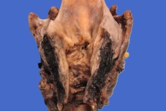 Squamous cell carcinoma of the larynx