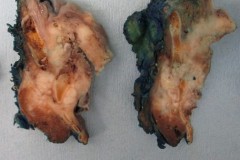 Squamous cell carcinoma of the larynx