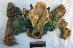 Squamous cell carcinoma of the larynx