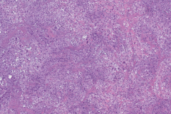 Poorly differentiated squamous cell carcinoma of the larynx