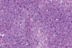 Poorly differentiated squamous cell carcinoma of the larynx