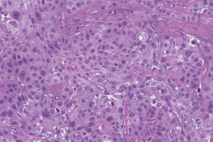 Poorly differentiated squamous cell carcinoma of the larynx