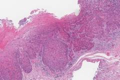 Squamous cell carcinoma of the larynx