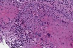 Squamous cell carcinoma of the larynx arising from a background of severe dysplasia