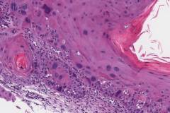 Squamous cell carcinoma of the larynx arising from a background of severe dysplasia