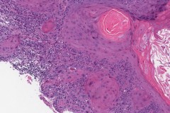 Squamous cell carcinoma of the larynx arising from a background of severe dysplasia