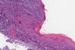 Squamous cell carcinoma of the larynx arising from a background of severe dysplasia