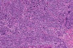 Metastatic squamous cell carcinoma of the cervix to the brain