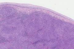 Squamous cell carcinoma of the cervix