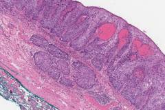 Squamous cell carcinoma of the esophagus