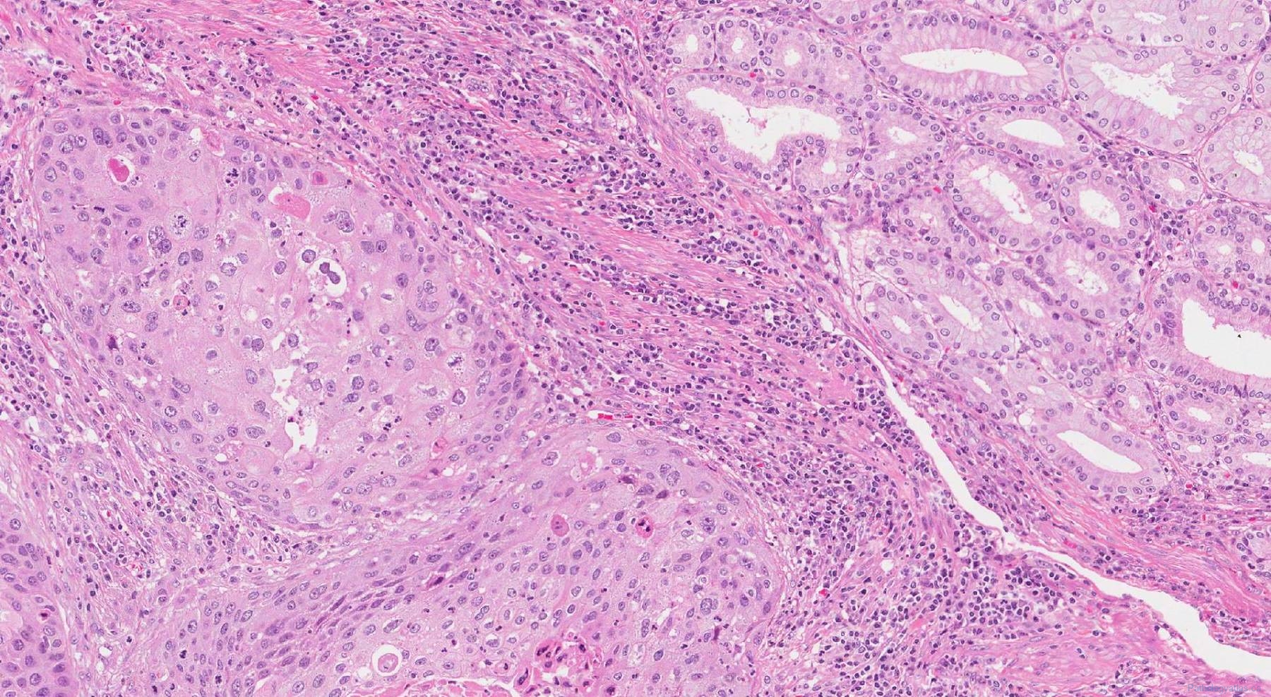 Squamous cell carcinoma of the gallbladder | Atlas of Pathology