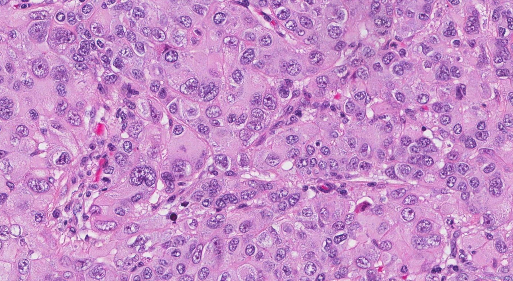 Squamous cell carcinoma of the lung | Atlas of Pathology