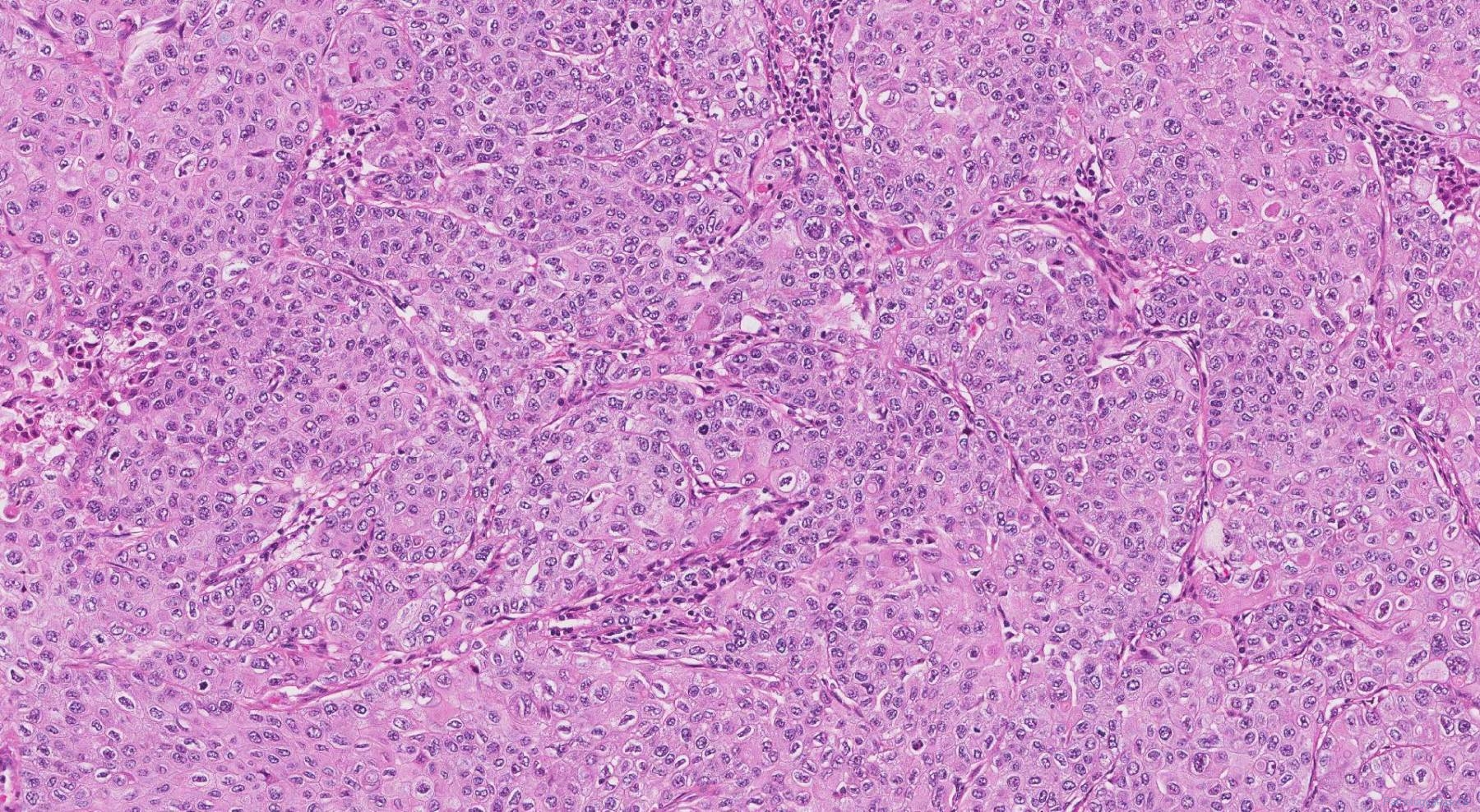 Squamous cell carcinoma of the lung | Atlas of Pathology