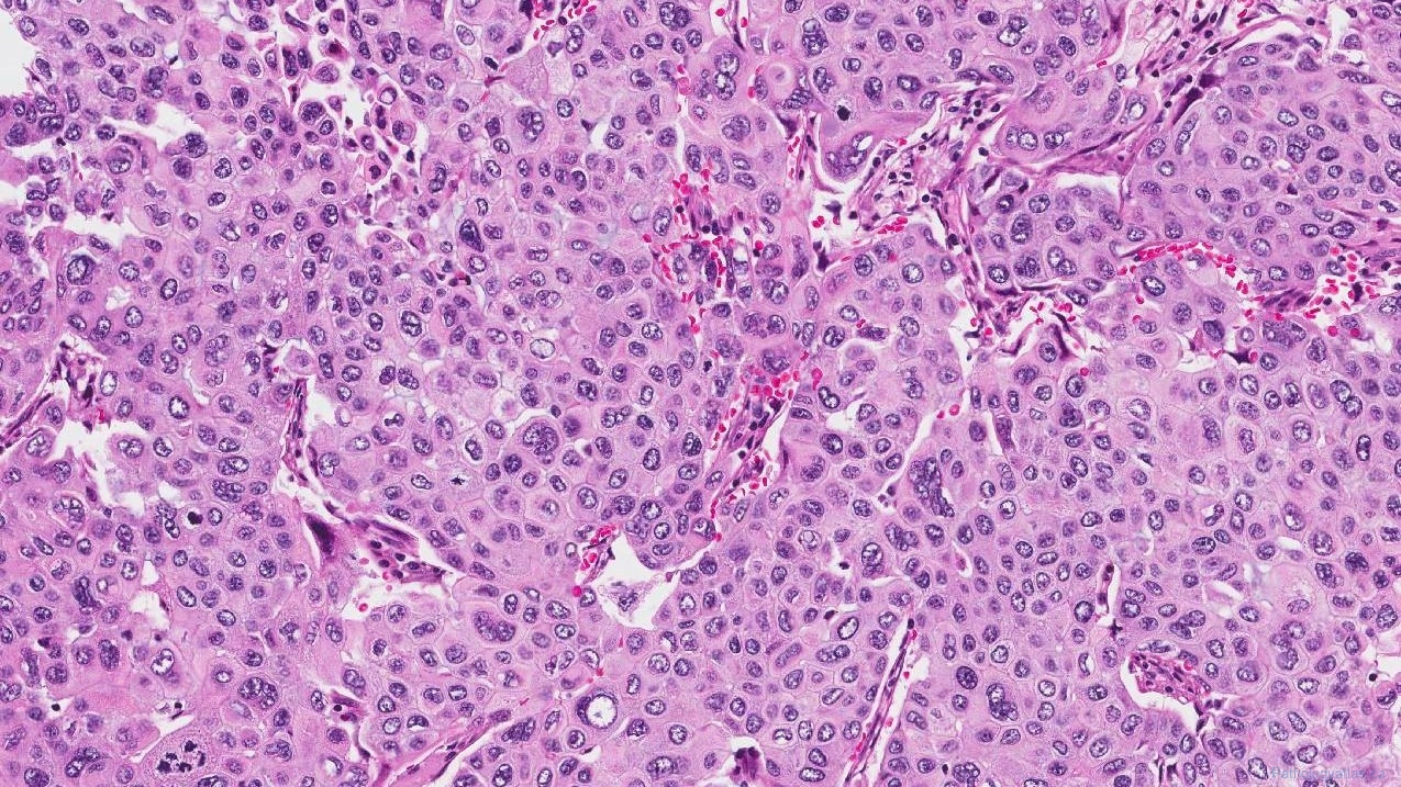 Squamous cell carcinoma of the lung | Atlas of Pathology