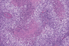 Metastatic squamous cell carcinoma from the skin to the skin