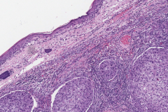 Metastatic squamous cell carcinoma from the skin to the skin