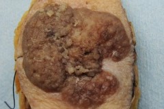 Squamous cell carcinoma of the skin