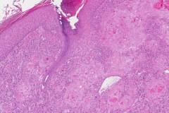 Squamous cell carcinoma of the skin