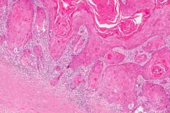 Squamous cell carcinoma of the skin