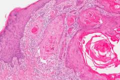 Squamous cell carcinoma of the skin