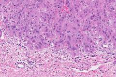 Squamous cell carcinoma of the skin