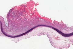 Squamous cell carcinoma of the external ear