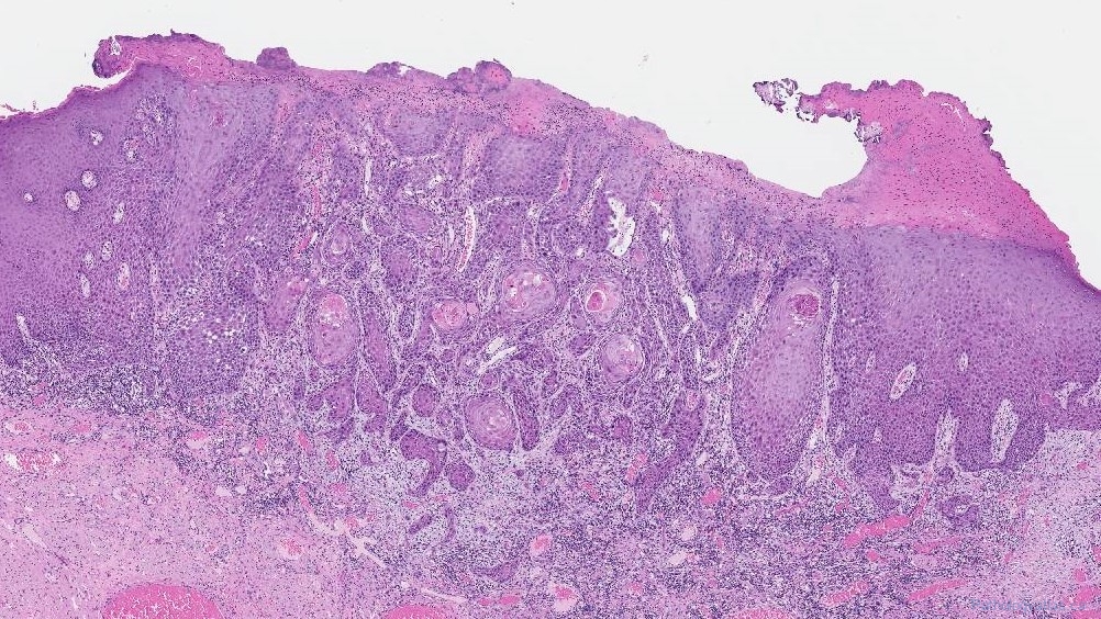 Squamous cell carcinoma of the oral cavity | Atlas of Pathology