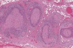 Squamous cell carcinoma of the oral cavity