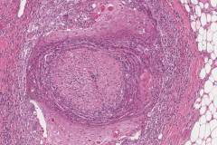 Squamous cell carcinoma of the oral cavity