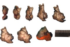 Squamous cell carcinoma of the tongue  and floor of mouth