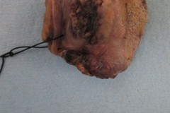 Squamous cell carcinoma of the tongue