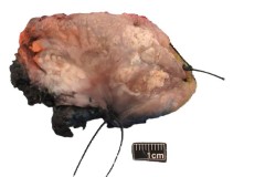 Squamous cell carcinoma of the tongue