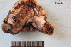 Squamous cell carcinoma of the floor of mouth