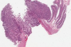 Metastatic squamous cell carcinoma of the tongue to the small intestine