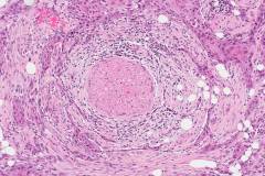 Squamous cell carcinoma of the oral cavity