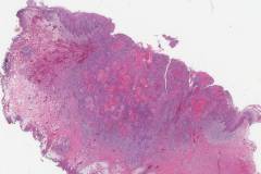 Squamous cell carcinoma of the oral cavity