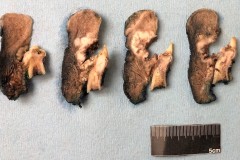 Squamous cell carcinoma involving the floor of mouth and ventral tongue