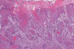 Squamous cell carcinoma of the oral tongue