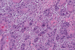 Squamous cell carcinoma of the oral cavity