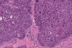 Squamous cell carcinoma of the oral cavity: Atypical mitoses