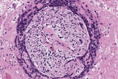 Squamous cell carcinoma of the oral cavity