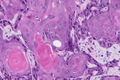 Squamous cell carcinoma of the oral cavity