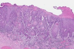 Squamous cell carcinoma of the oral cavity