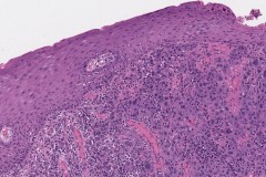 Squamous cell carcinoma of the oral tongue