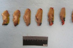 Squamous cell carcinoma of the tongue