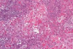 Squamous cell carcinoma of the oral tongue