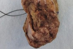 Squamous cell carcinoma of the tongue and floor of mouth