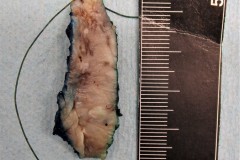 Squamous cell carcinoma of the tongue